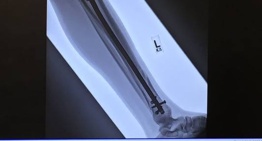 Stranded on a Fourteener with A Spiral Fracture